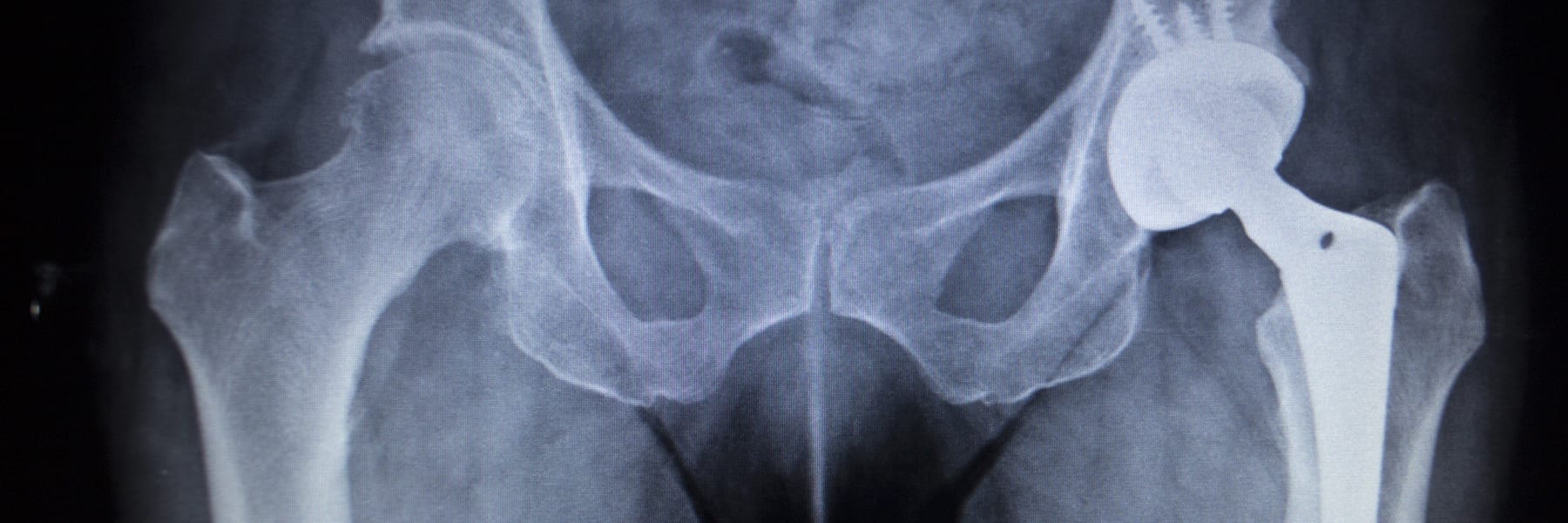 DePuy Metal Hip Recall Harrison Davis Morrison Jones